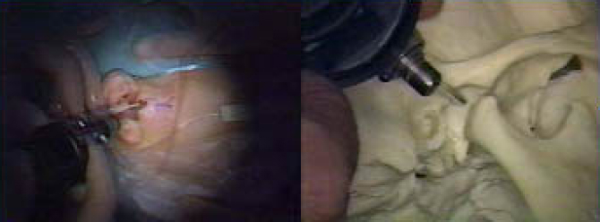 関節腔注射・徒手的円板整位術