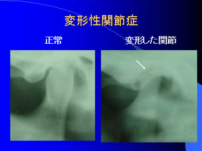 変形性顎関節症