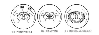 嚥下内視鏡検査の方法